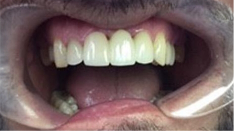 Smile with a dental bridge