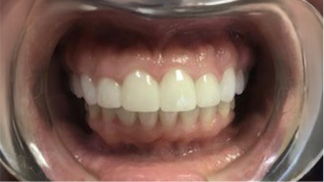 Close up of teeth after dental crowns