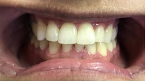 Close up of teeth straightened by orthodontics