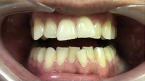 Close up of misaligned teeth