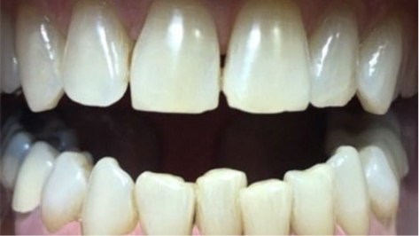 Close up of whitened teeth