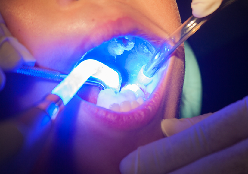 Close up of sealants being applied to teeth