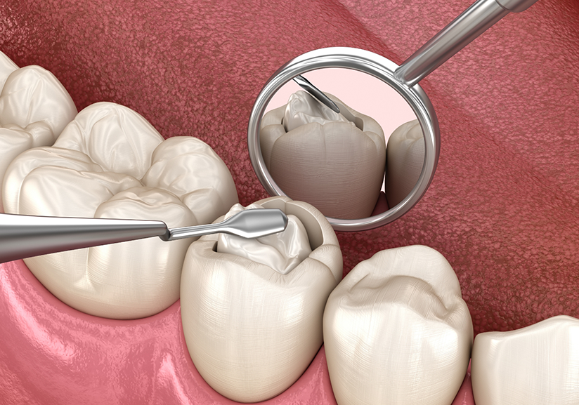 Illustration of tooth being treated