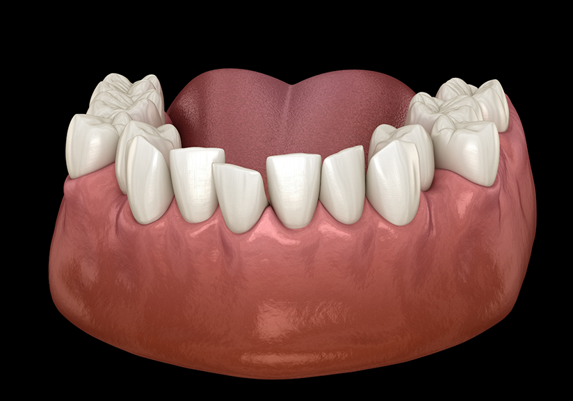 Illustration of misaligned teeth