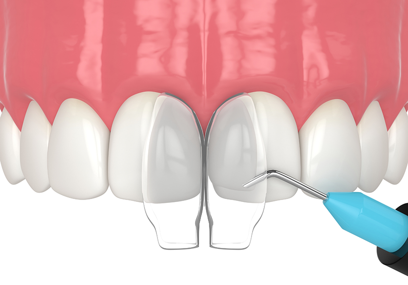 Illustration of cosmetic bonding being performed on upper teeth