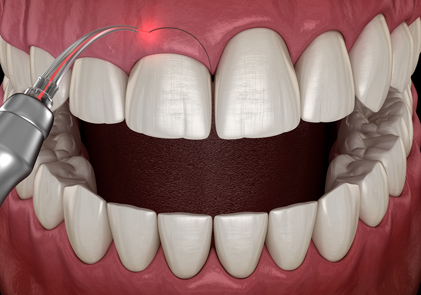 Illustration of laser being used for gum recontouring