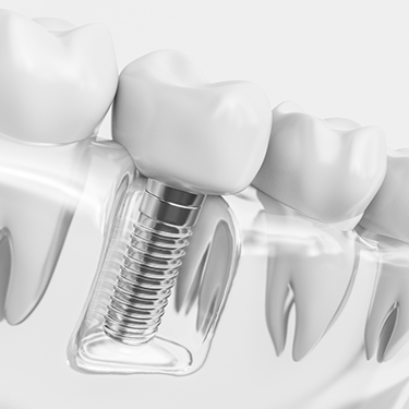 Illustration of single dental implant