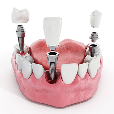 Illustration of multiple dental implants being placed