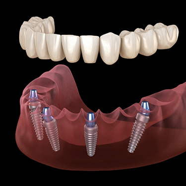 Illustration of dentures being placed on dental implants