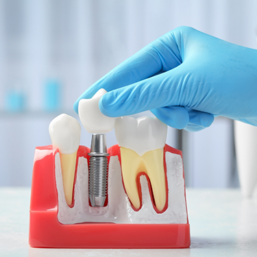 Taking crown off model of dental implant