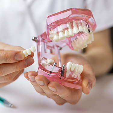 Holding dental bridge and model of mouth with dental implants