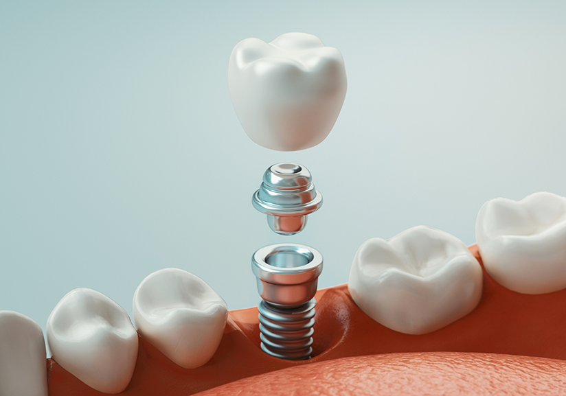 Illustration of dental implant in Pantego being placed with crown and abutment