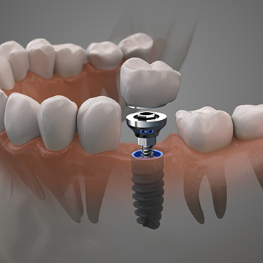 Illustration of dental implant in jaw