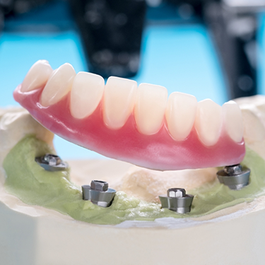 Dentures above model of dental implants