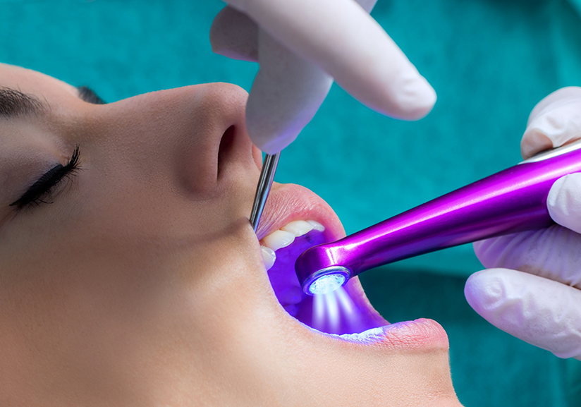 Close up of mouth open while receiving dental sealants