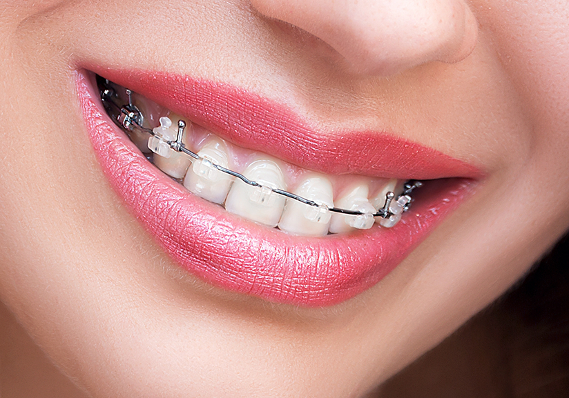 Close-up of smile with clear braces