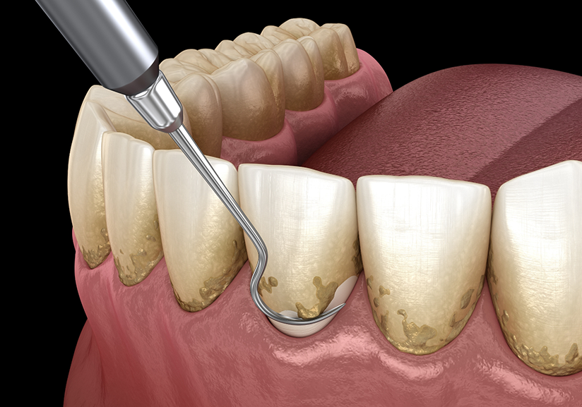 Illustration of scaling and root planing being performed for lower teeth