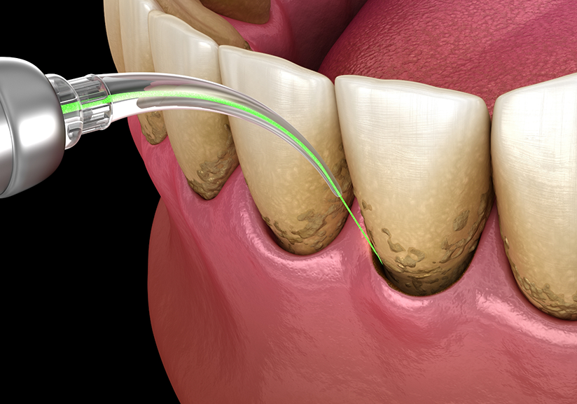 Laser periodontal treatment being performed for lower teeth