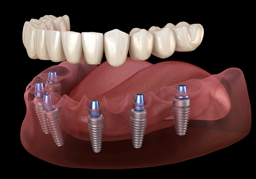 Illustration of dentures being attached to dental implants