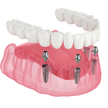 Illustration of implant dentures in Pantego being placed