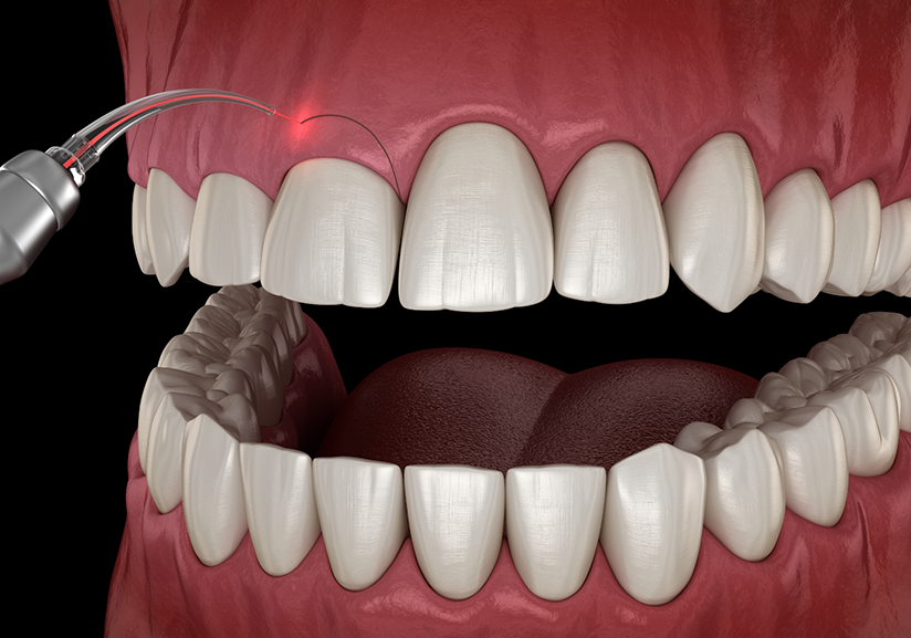 Illustration of gums being treated with dental laser