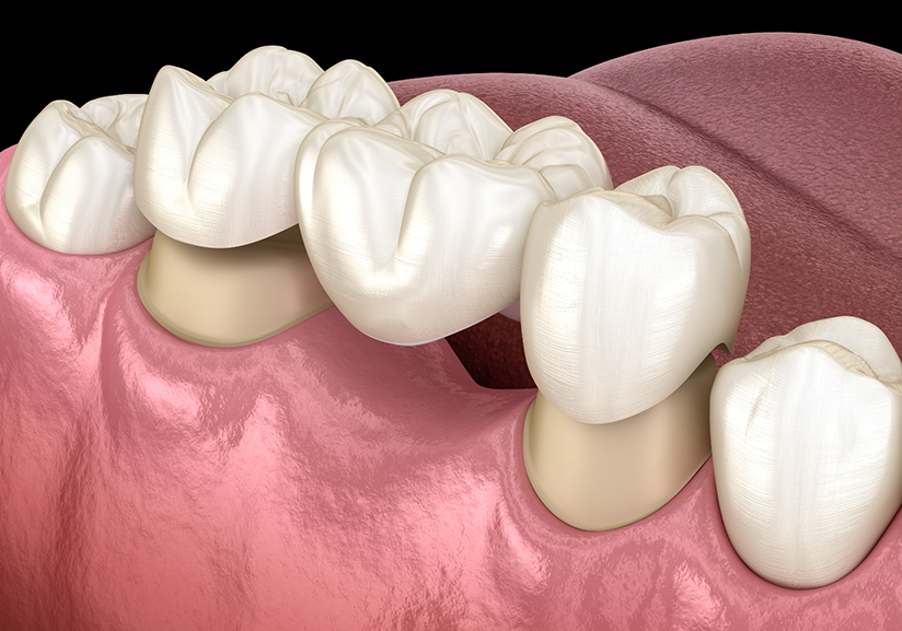 Illustration of dental bridge being placed on teeth