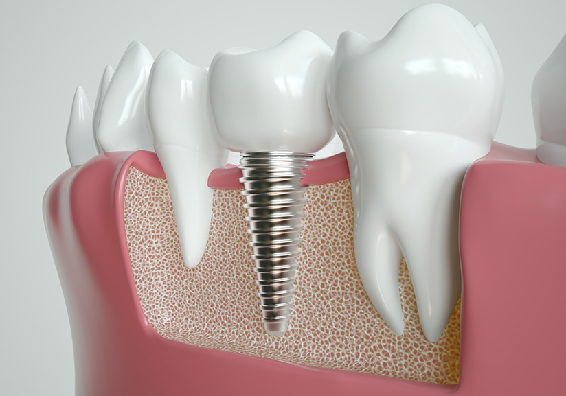 Illustration of dental implant between natural teeth