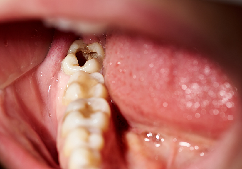 Close-up of badly decayed teeth