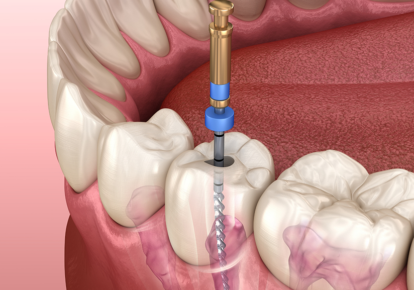 Illustration of root canal treatment in Pantego for lower teeth