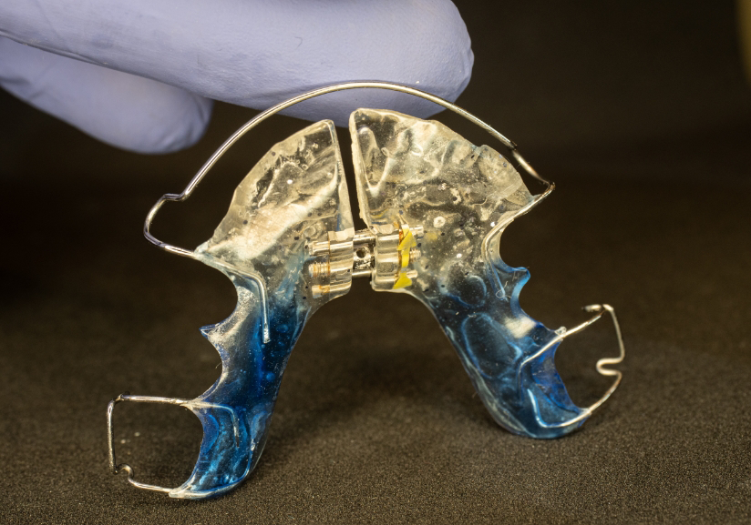 Close-up of oral appliance for treating sleep apnea