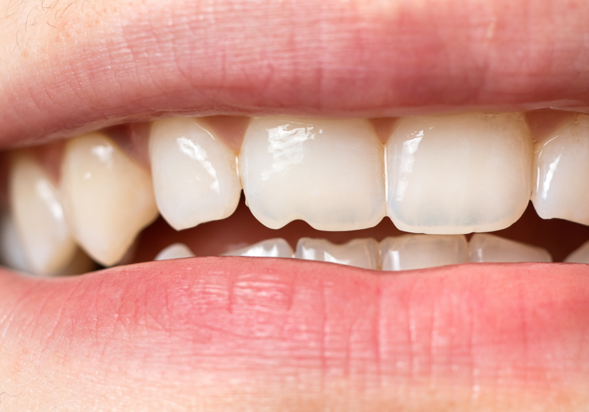 Close-up of smile with chipped tooth