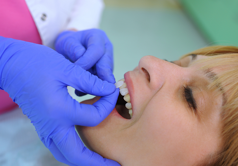 Placing veneer on female patient's teeth