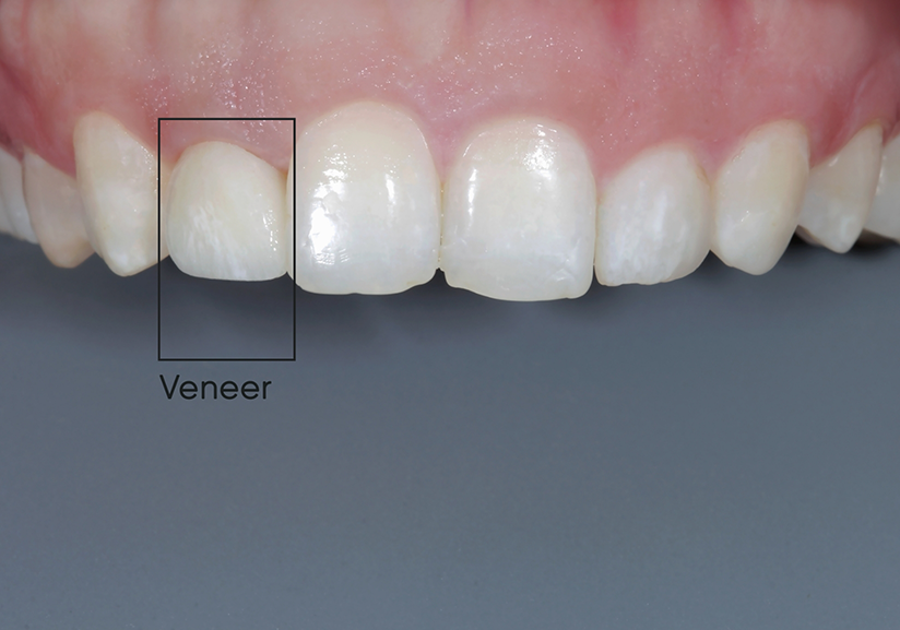 Close-up of smile with rectangle used to show veneer